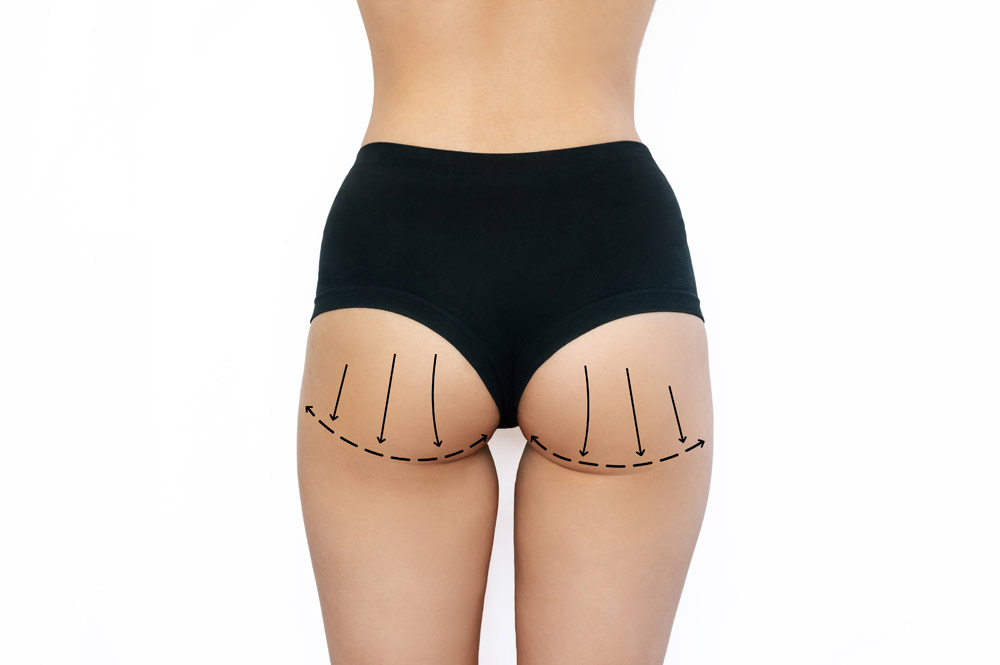 lipofilling des fesses